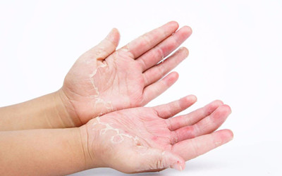 手部湿疹应该如何治疗